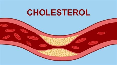 Kolesterol dibawah 200, Tapi tetap pasang Ring ???